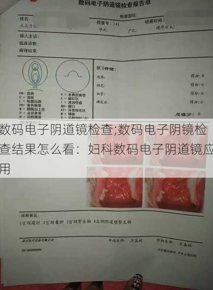 数码电子阴道镜检查;数码电子阴镜检查结果怎么看：妇科数码电子阴道镜应用