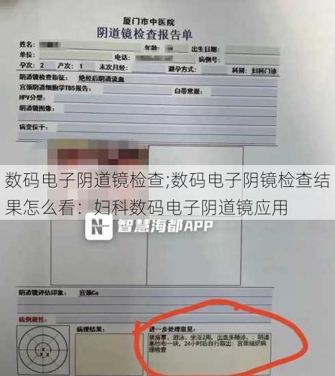 数码电子阴道镜检查;数码电子阴镜检查结果怎么看：妇科数码电子阴道镜应用